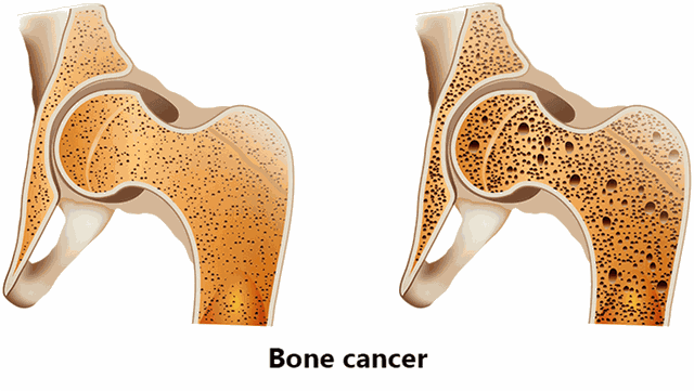 Các triệu chứng thường gặp của ung thư xương